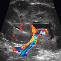 Ультразвуковое исследование почечных артерий